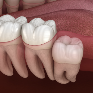 Wisdom Teeth Removal