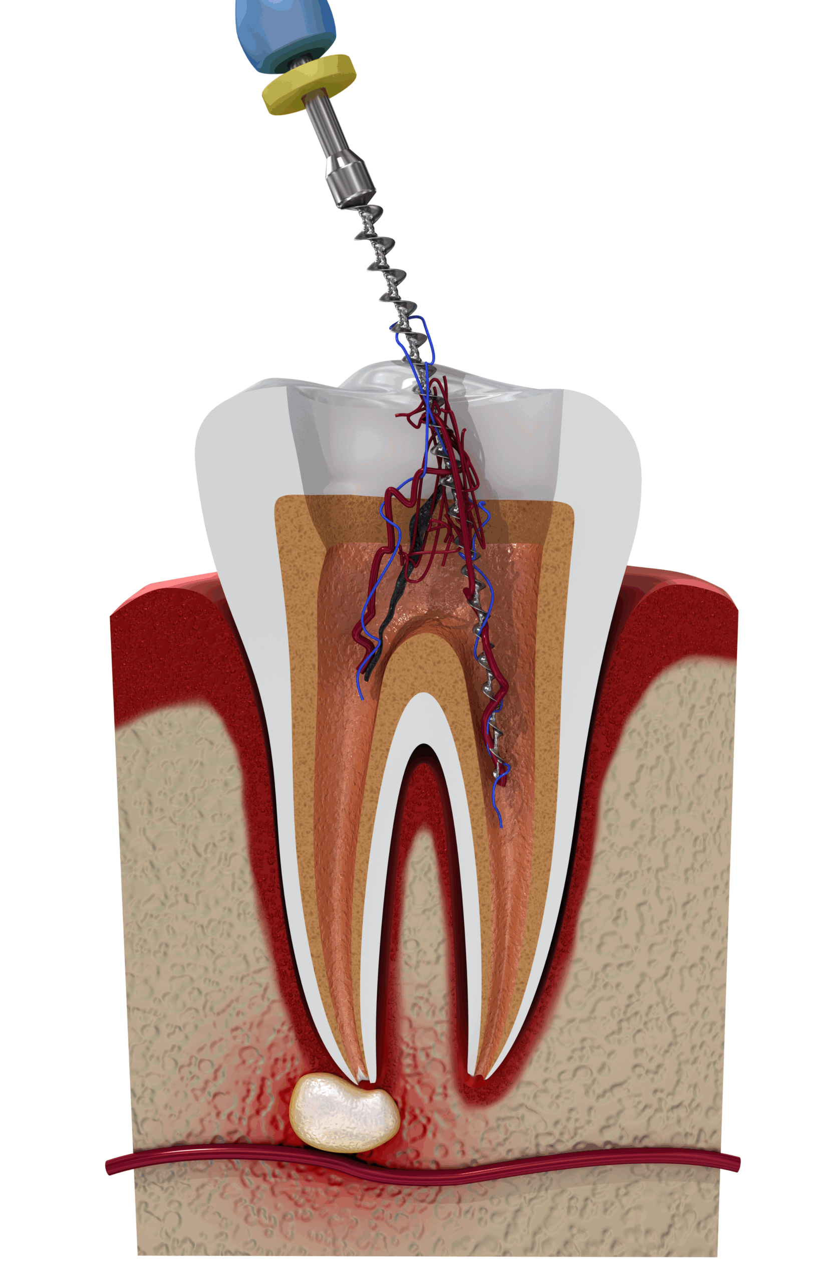 Root Canal Treatments