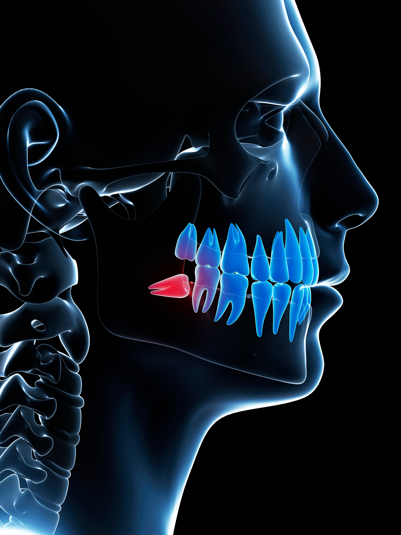 Wisdom Teeth Removal Bundoora